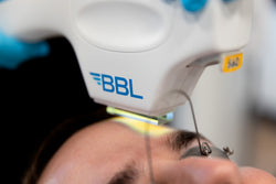 BBL Laser Treatment
