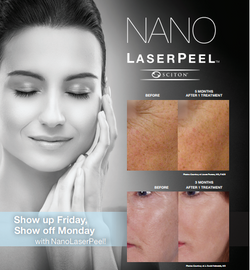 Nano Laser Peel